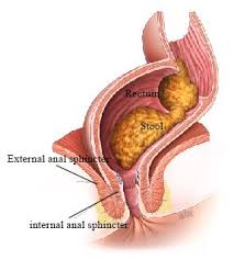 Fistula Treatment in Gudiyari, Raipur - Shri Ganpati Piles Clinic