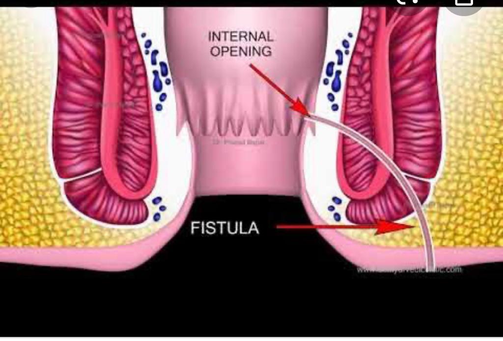 Fistula Treatment in Gudiyari, Raipur - Shri Ganpati Piles Clinic